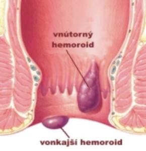 Čo sú HEMOROIDY ? ( „ zlatá žila “ )